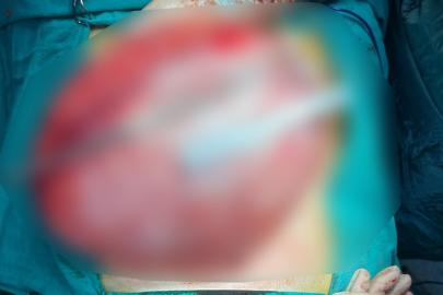 Kilo vermek için hastaneye giden çocuğun karnından 3,5 kiloluk kist çıktı