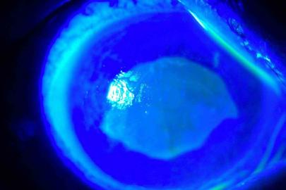 ’Kırlangıç otu kullanımı’na dikkat, uzmanlar uyarıyor: "Gözlerine suyunu damlattı, göremez hale geldi"