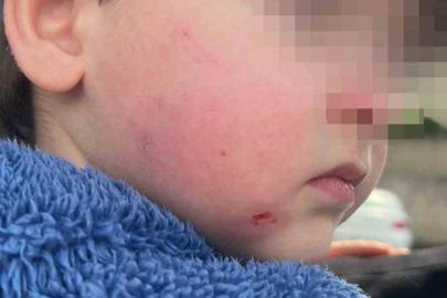 Kreşe bıraktığı çocuğunu darp edilmiş halde aldı
