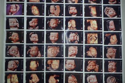 7 yıllık bebek hasreti "kişiye özel" tedaviyle son buldu