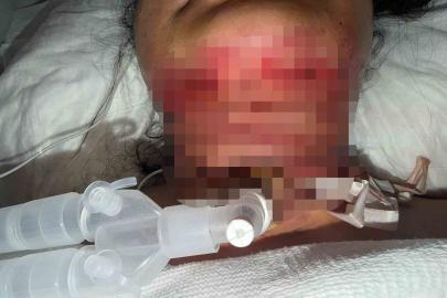 Gıdı estetiği sonrası nefes alamadı, boynundan acil solunum yolu açıldı
