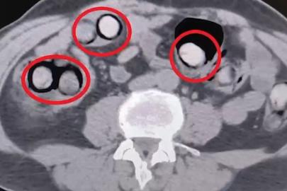 Mide ve bağırsaklarından 758 gram uyuşturucu çıktı